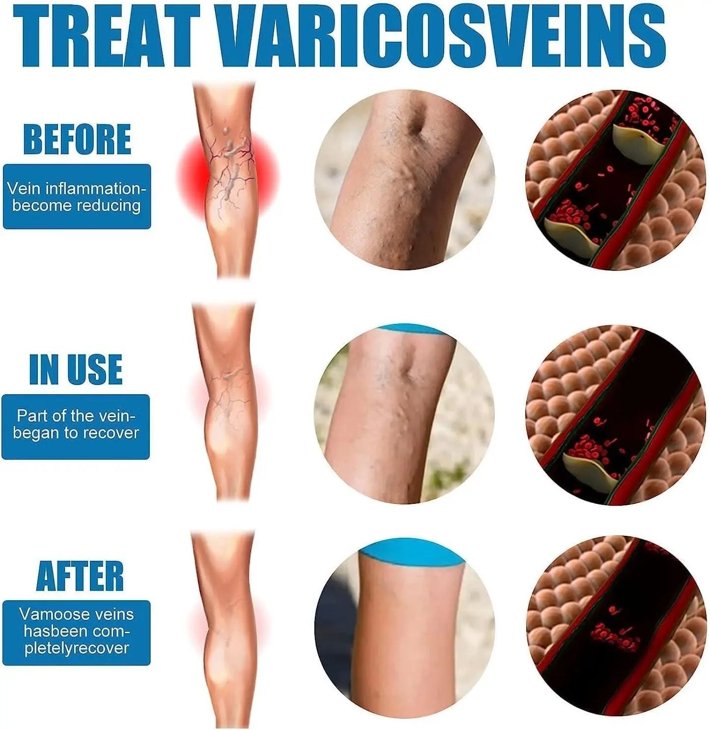 Vein Healing Varicose Veins Treatment Spray ( Pack of 2 )